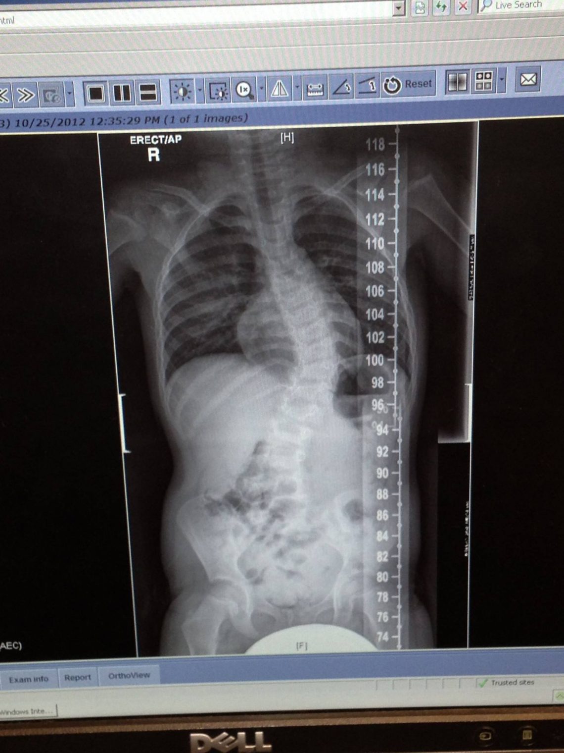 Scoliosis