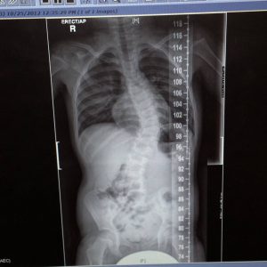 Scoliosis