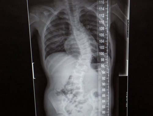 Scoliosis